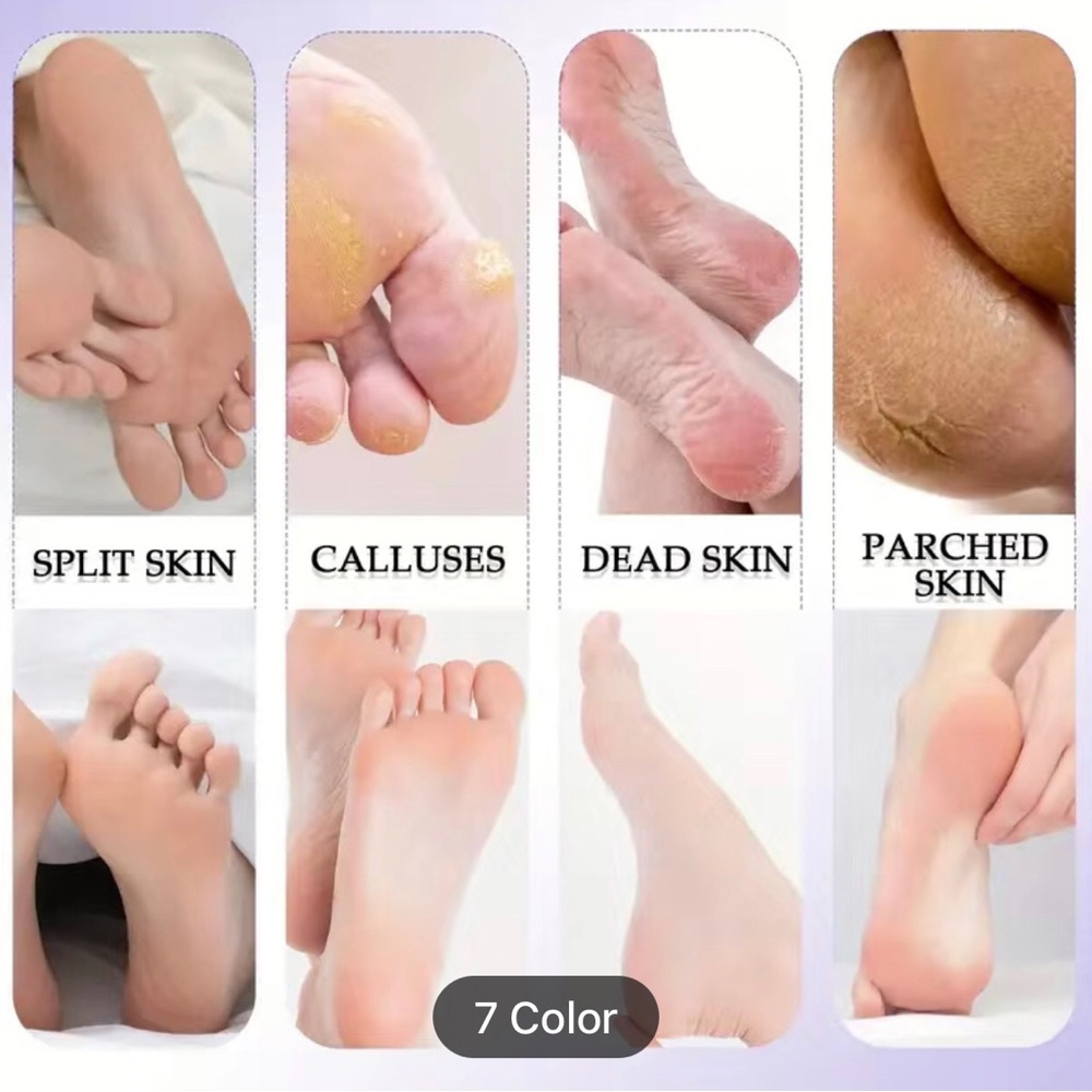 Callus Remover Kit - Picture 11 of 16